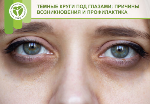 Почему возникают коричневые круги вокруг глаз: причины и способы их устранения